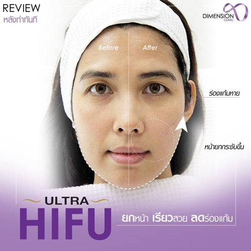  Ultra Hifu 8900 11 ӡѴ͵ԧ Ŵ˹§Ŵҧ¡˹Ǩԧ